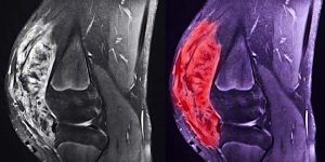 Image shows an X-ray of two arms with a lump identified.